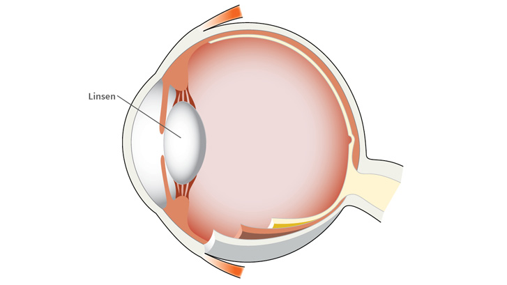 Linsen tilpasser øjets fokus på kort afstand.
