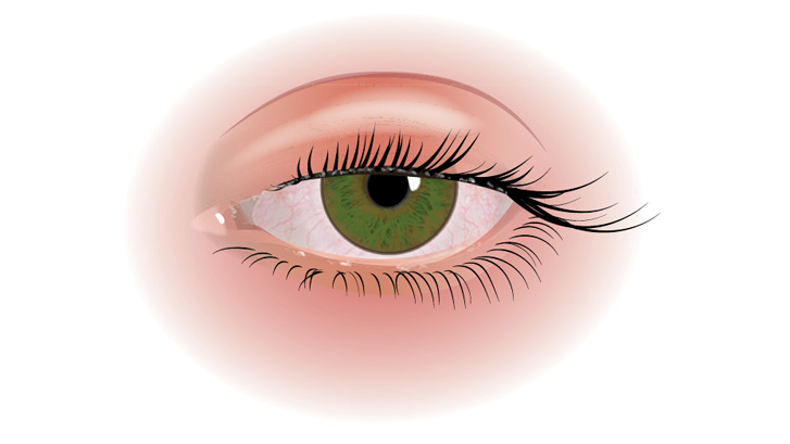 Blefarit, Blefaritis