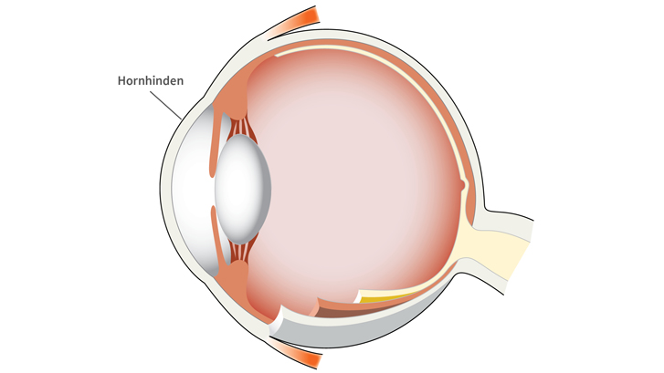 Hornhinden bryder lyset i øjet.