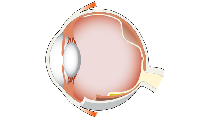 Nethindeløsning indebærer at nethinden løsner sig fra sin faste placering ved årehinden.