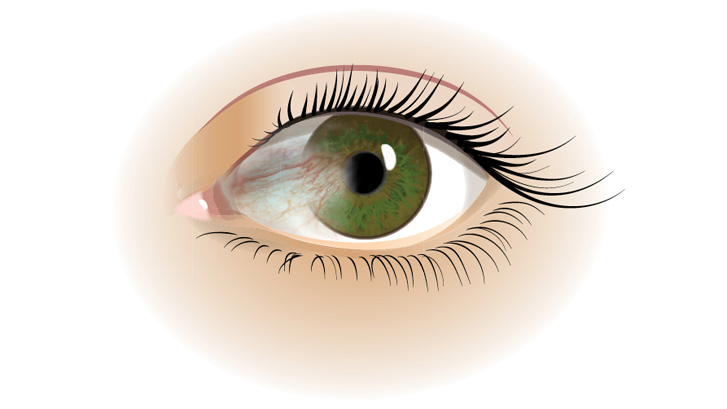 Pterygium ligner en rødlig trekant som vokser i det hvide i øjet.